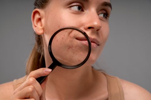 צלקות אקנה – כשסימני העבר נשארים על הפנים